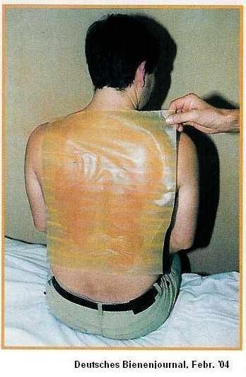 Wax treatment against back pains